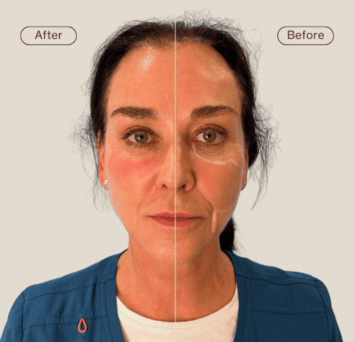 polynucleotides skin refresh before and after results - post summer skin