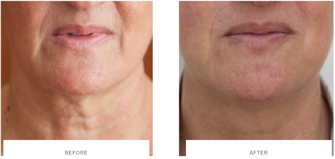 profhilo neck before and after