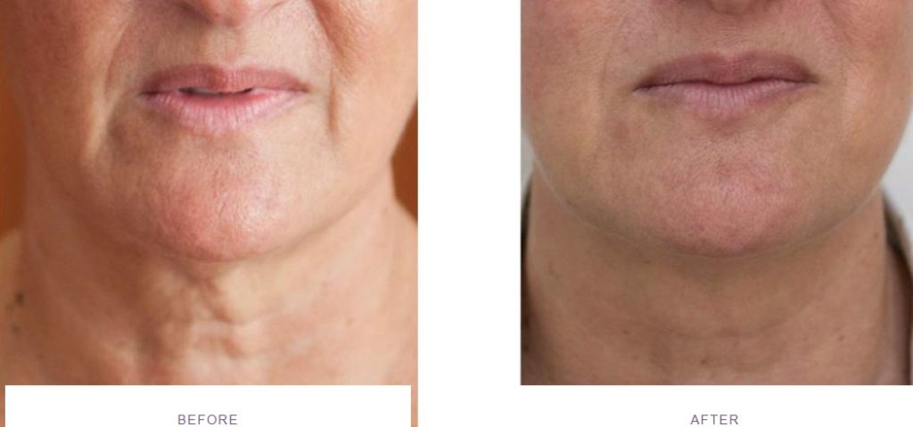 profhilo neck before and after