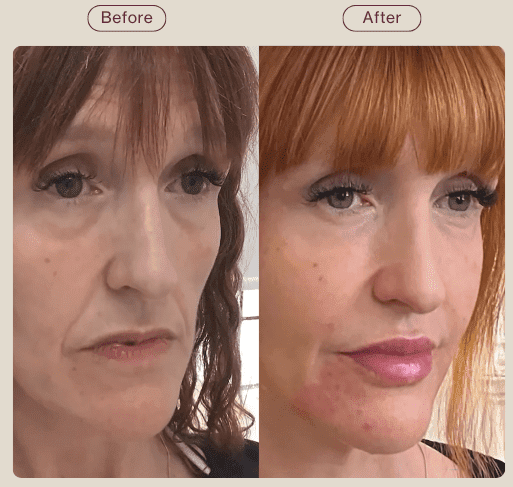 profhilo skin hydration before and after results - post summer skin