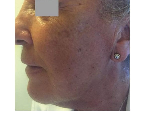Profhilo Skin Tightening Treatment After Photo