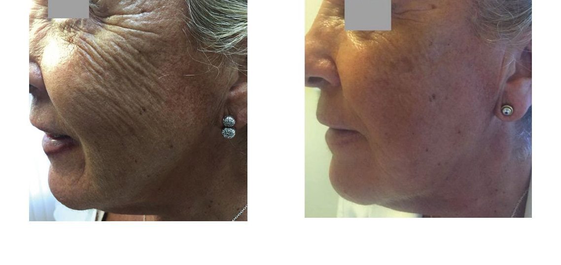 profhilo skin treatment on face before and after