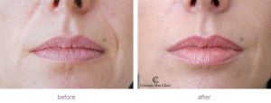 Lip fillers