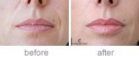 Restylane Lip hydrating treatment