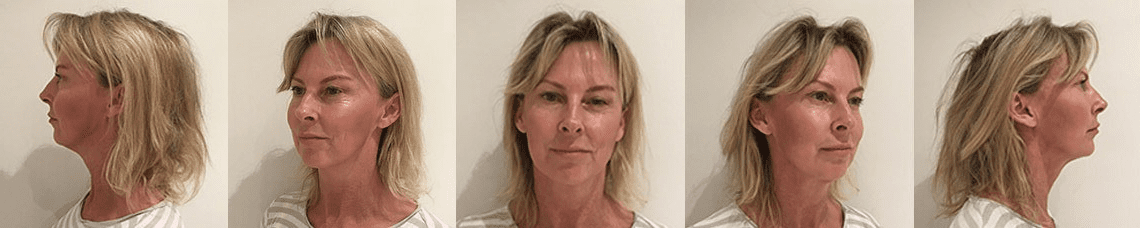 rejuvenating menopausal skin-after 3 months results