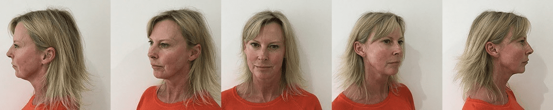rejuvenating menopausal skin before and after
