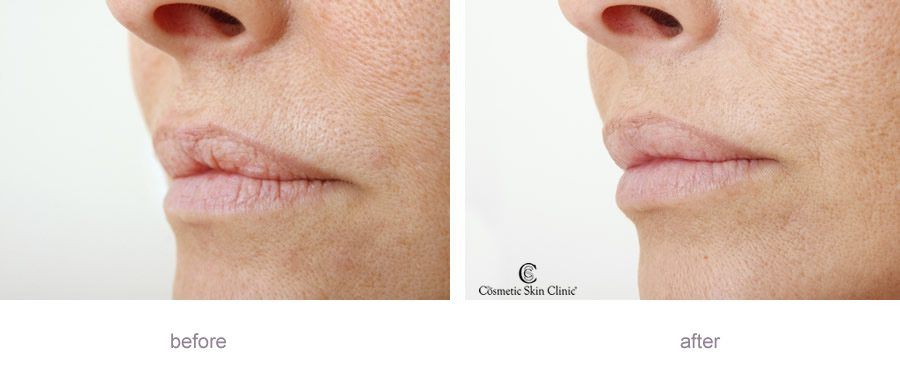 restylane-Lip Refresh