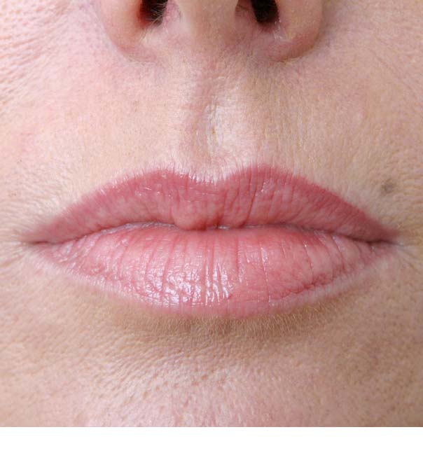 Lip Enhancement & Lip Augmentation Before & After