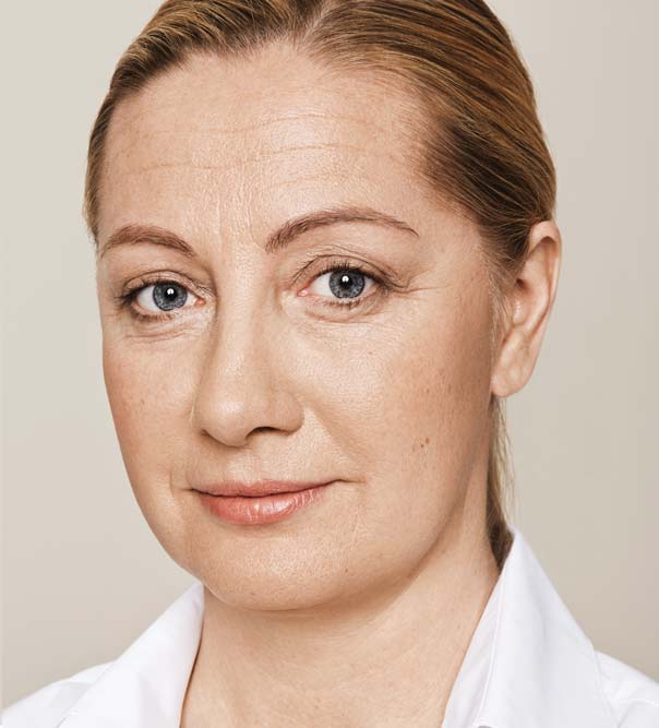 A lady before Restylane treatment to the cheeks, tear troughs and forehead