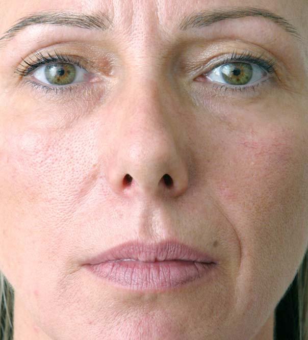 A lady before lower face and lip treatment