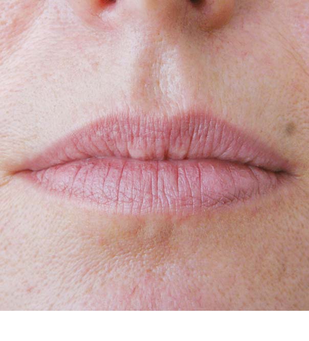 A close up of lips before Skinboosters treatment