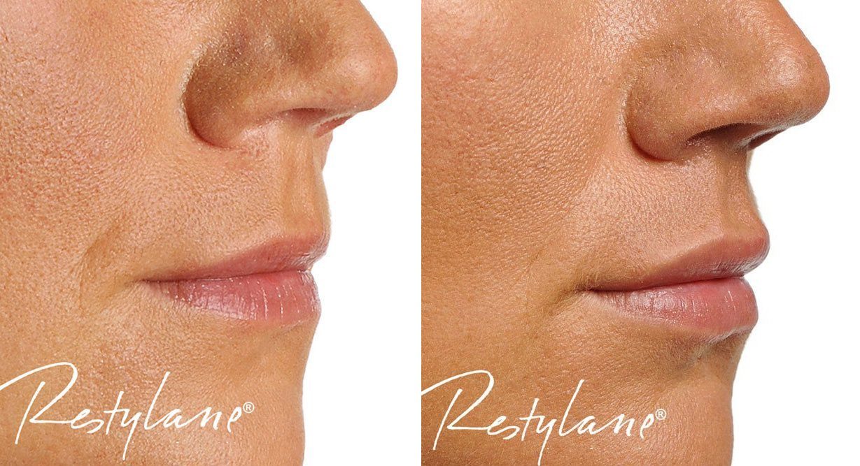 restylane lip filler before and after