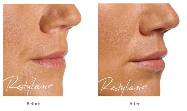 Restylane Lip Filler Before and After