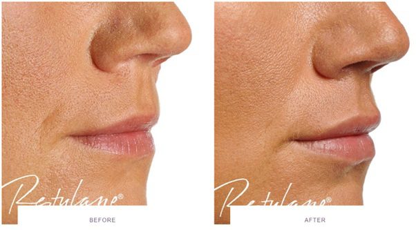 restylane lip fillers before and after