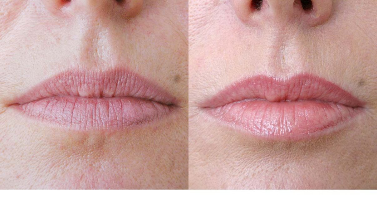 restylane lip fillers before and after