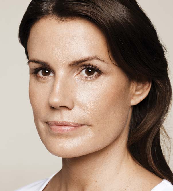 A lady after treatment with Restylane Skinboosters