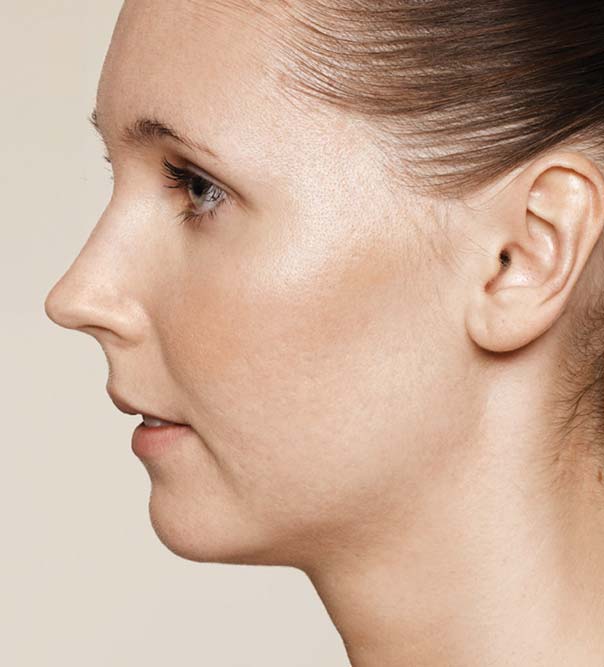 A lady with reduced acne scarring after Restylane treatment