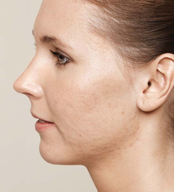 A lady with acne scarring