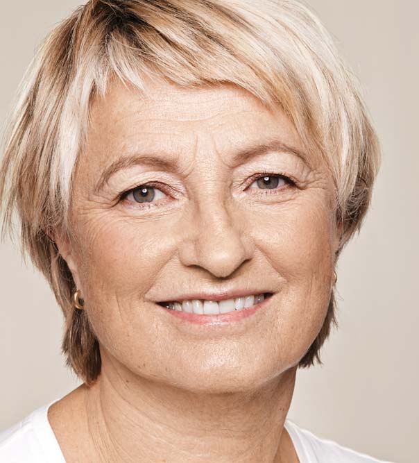 A lady before having Restylane treatments to the face