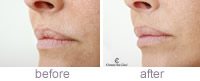 Restylane Vital Lip Enhancement