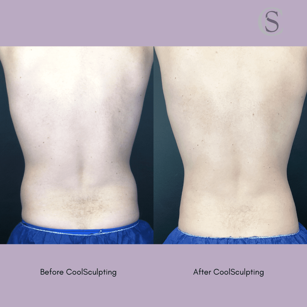 coolsculpting before and after love handles