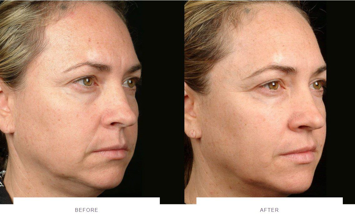 sagging jowls thermage before and after