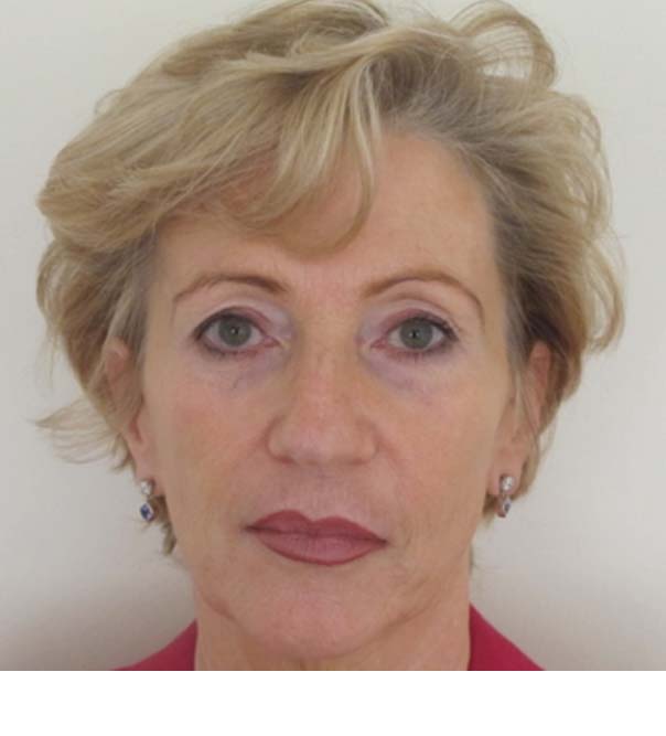 A lady's face following a Sculptra Liquid Facelift