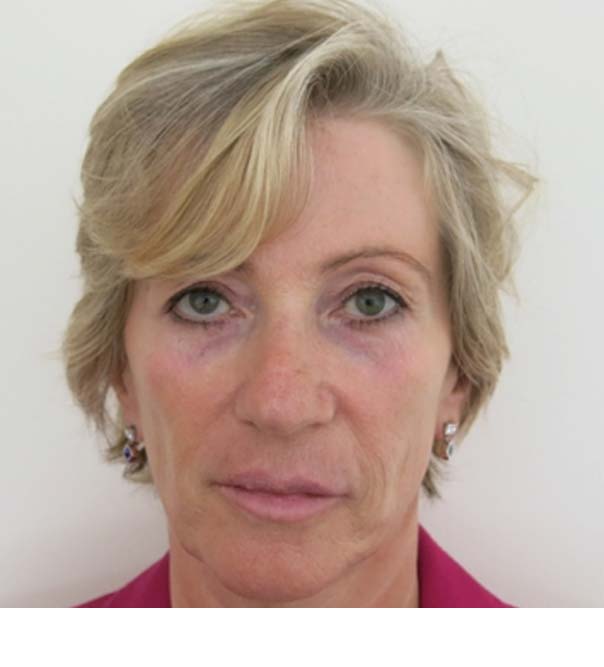 A lady before a Liquid Facelift