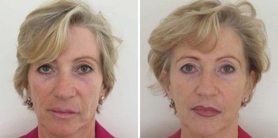 sculptra non surgical facelift before and after
