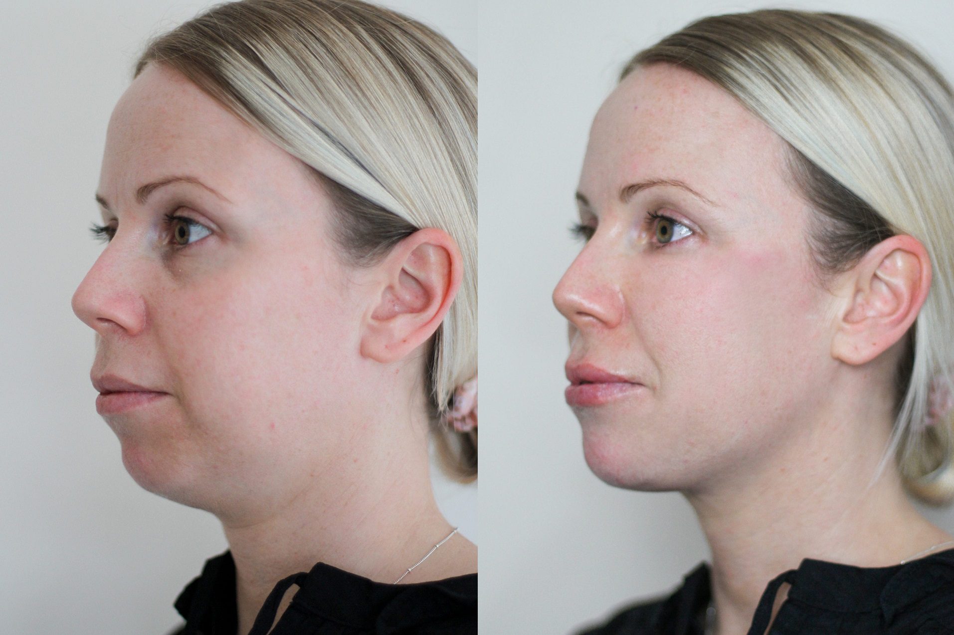 sharpen jawline with filler before and after