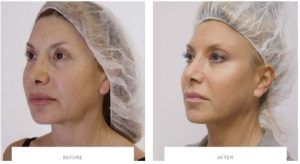 silhouette soft facelift treatment before after