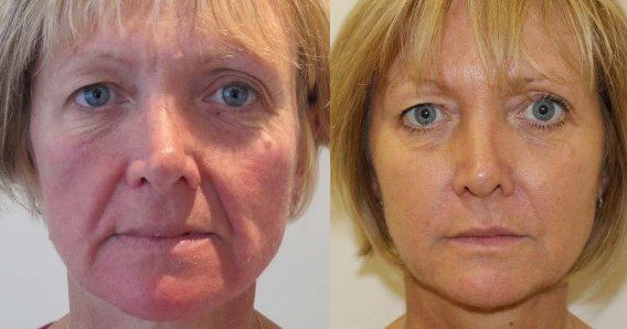 thread facelift before and after