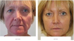 silhouette soft thread lift facelift before after