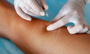 spider veins treatment london