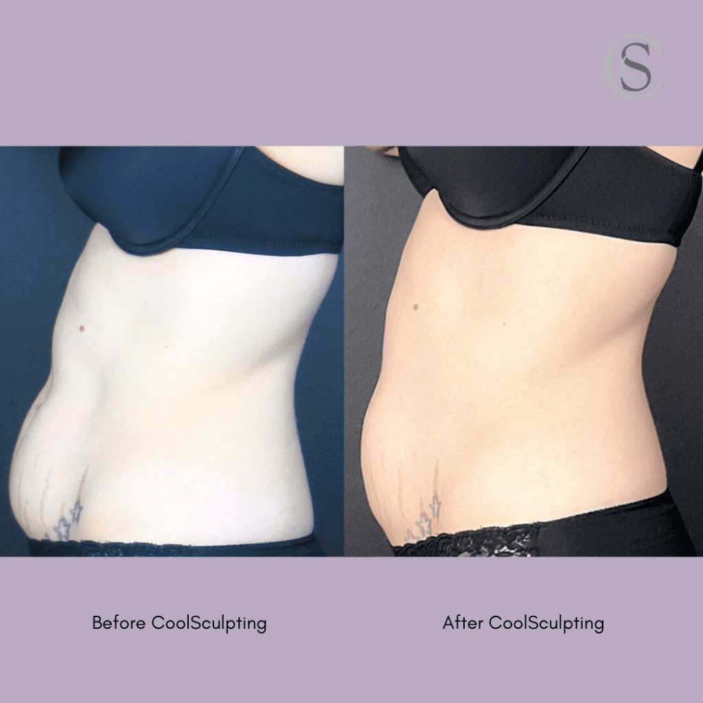 coolsculpting mummy tummy before after, belly fat before after