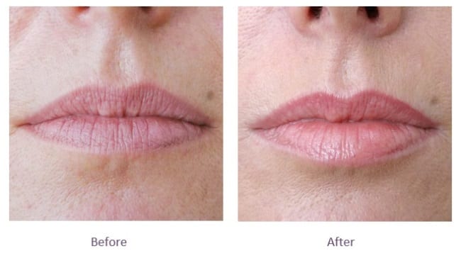 Subtle lip fillers before and after