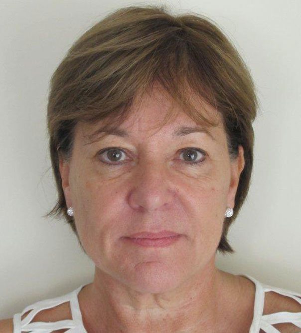 A lady after having dermal fillers to reduce dark circles under the eyes