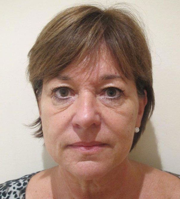 A lady before having treatment to the tear troughs