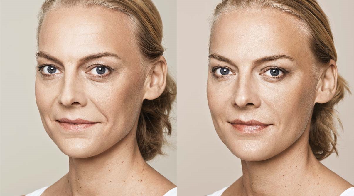 Tear Trough Filler Near Me in London & Buckinghamshire Tear Trough Dermal Fillers The
