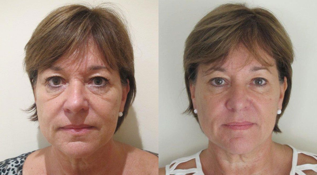 tear trough filler tired eyes before and after