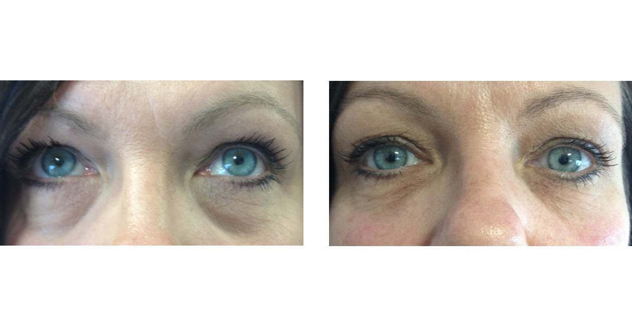 tear trough filler under eye bags eye wrinkles before and after