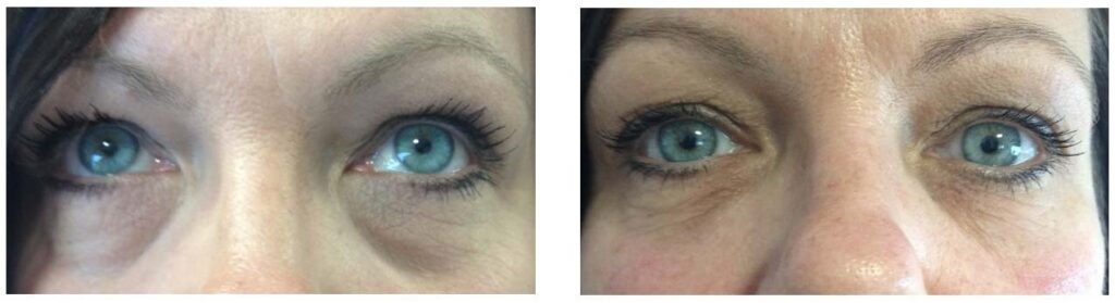 tear troughs filler before and after results