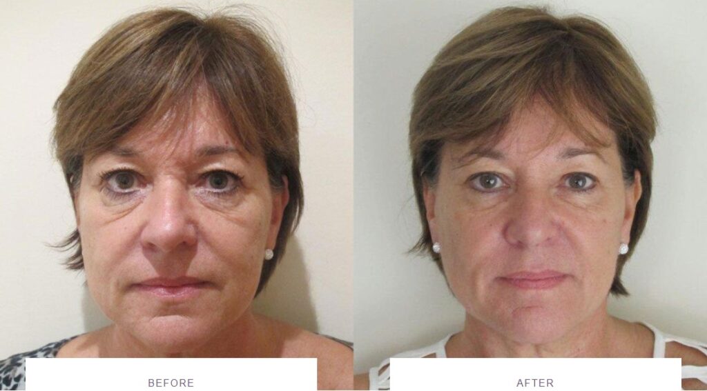 tear troughs tired eyes dermal filler before and after