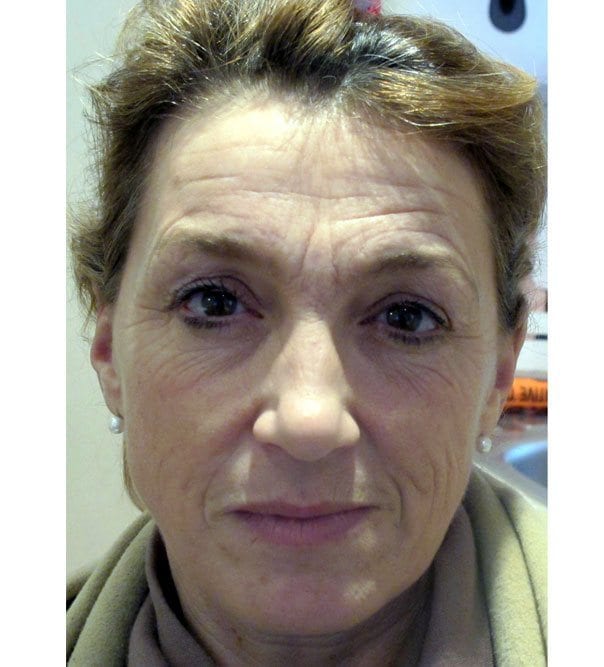 Patient before facial rejuvenation with temple fillers