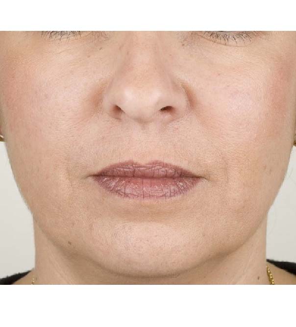 A lady after having Teosyal treatment