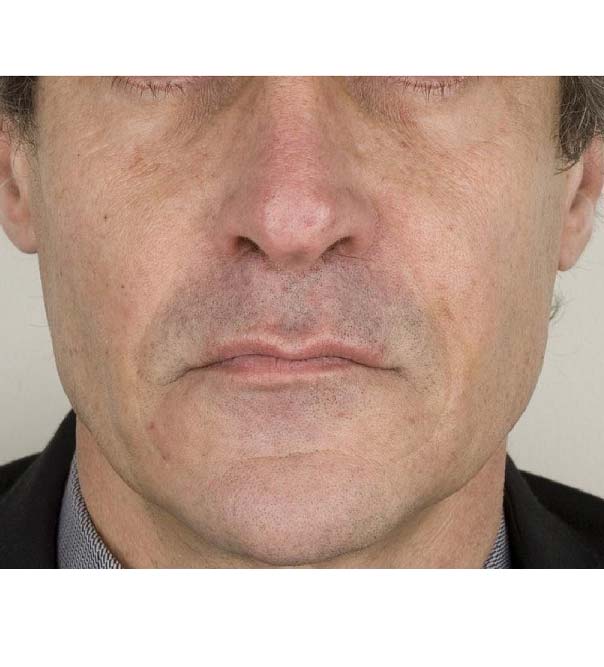 A man's face following treatment to the nasolabial folds with Teosyal