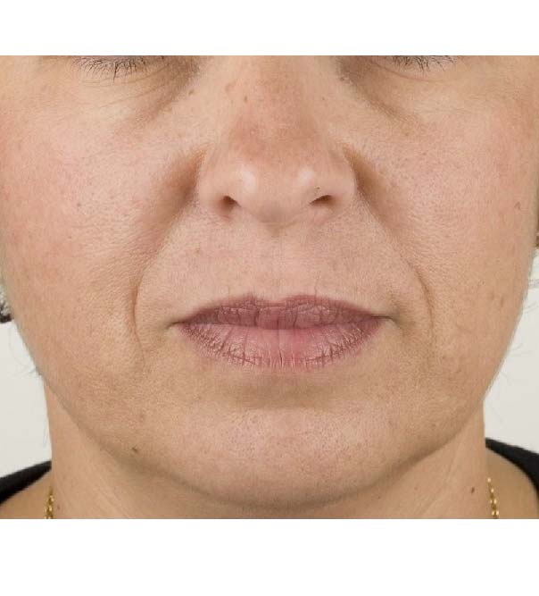 A close up of a lady's face before Teosyal treatment
