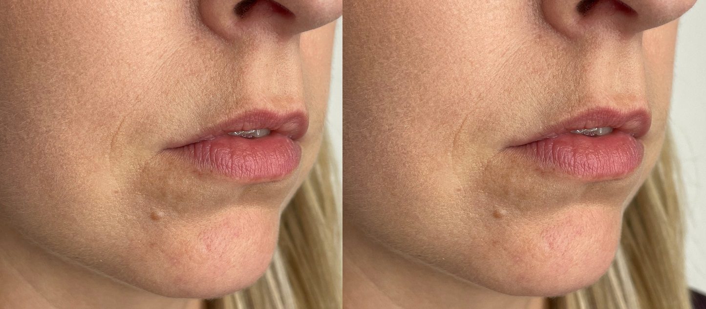 teoxane Dermal-Filler-lip-lines-barcode-lines-before-and-after-Sylvia-Chrzanowska-2