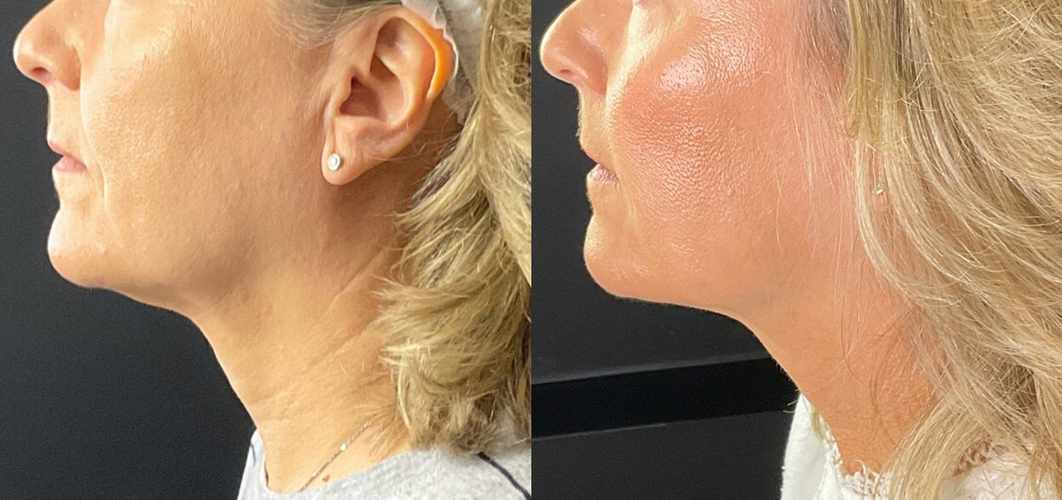 teoxane Dermal-fillers-and-morpheus8-face-and-neck-wrinkles-before-and-after
