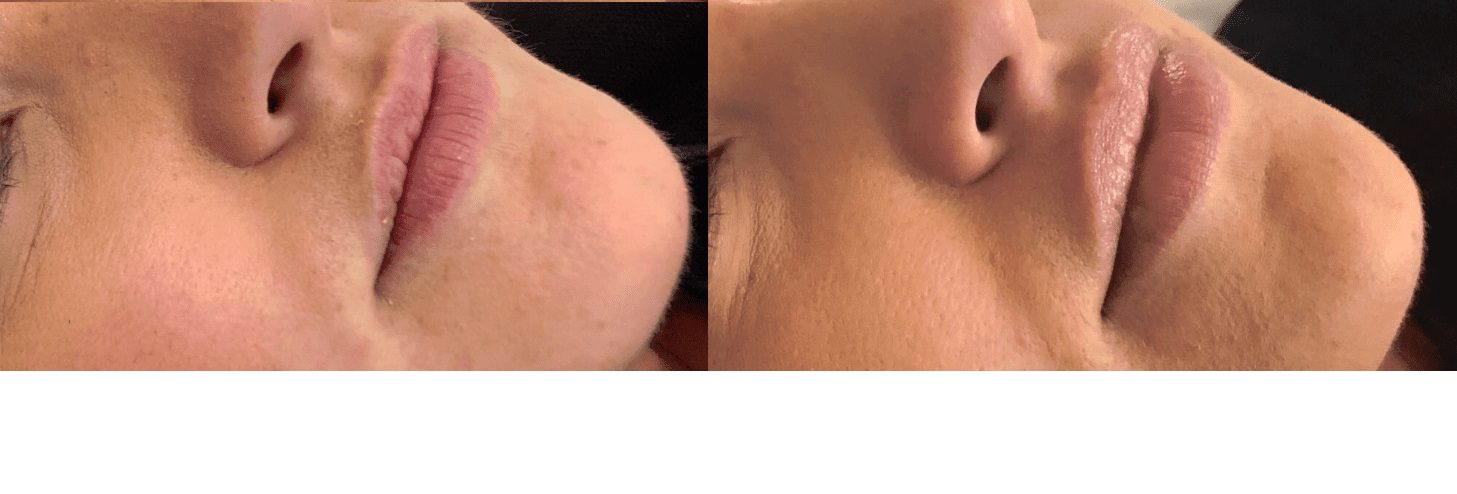 teoxane fillers-in-the-lips-before-and-after